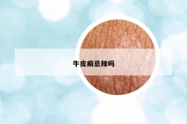牛皮癬忌辣嗎