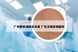 廣州銀屑病精定夫康 廣東治銀屑病醫(yī)院