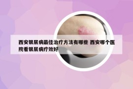 西安銀屑病最佳治療方法有哪些 西安哪個(gè)醫(yī)院看銀屑病療效好