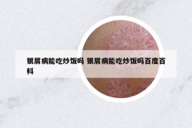 銀屑病能吃炒飯嗎 銀屑病能吃炒飯嗎百度百科