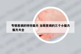 專銀屑病的特效偏方 治銀屑病的三個小偏方 偏方大全