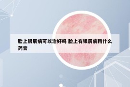 臉上銀屑病可以治好嗎 臉上有銀屑病用什么藥膏