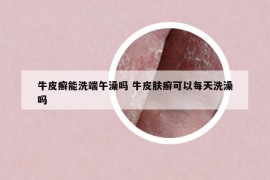牛皮癬能洗端午澡嗎 牛皮膚癬可以每天洗澡嗎
