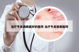 治療牛皮病癬最好的醫(yī)院 治療牛皮膚癬醫(yī)院