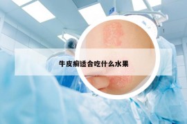 牛皮癬適合吃什么水果
