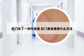 肛門長(zhǎng)了一塊牛皮癬 肛門表皮癬用什么方法