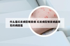 代么是紅皮病型銀屑病 紅皮病型銀屑病最常見的病因是