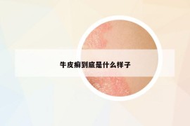 牛皮癬到底是什么樣子