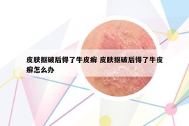 皮膚摳破后得了牛皮癬 皮膚摳破后得了牛皮癬怎么辦