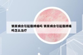 銀屑病會引起胳膊痛嗎 銀屑病會引起胳膊痛嗎怎么治療
