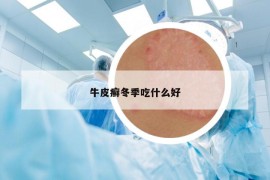 牛皮癬冬季吃什么好