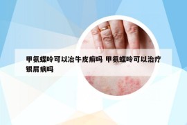 甲氨蝶呤可以冶牛皮癬嗎 甲氨蝶呤可以治療銀屑病嗎