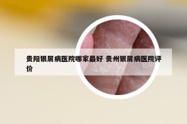 貴陽銀屑病醫(yī)院哪家最好 貴州銀屑病醫(yī)院評(píng)價(jià)