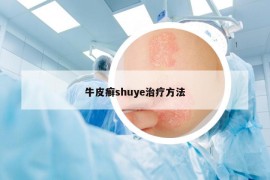 牛皮癬shuye治療方法