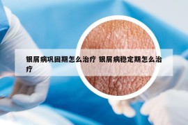 銀屑病鞏固期怎么治療 銀屑病穩(wěn)定期怎么治療