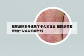 銀屑病照紫外線黑了多久能變白 銀屑病需要照射什么波段的紫外線