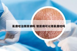 氟康唑治銀屑病嗎 銀屑病可以用氟康唑嗎