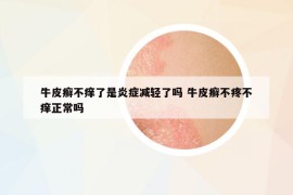牛皮癬不癢了是炎癥減輕了嗎 牛皮癬不疼不癢正常嗎