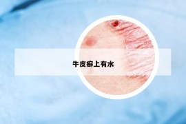 牛皮癬上有水