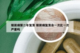 銀屑病第二年復(fù)發(fā) 銀屑病復(fù)發(fā)會一次比一次嚴(yán)重嗎