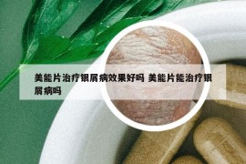 美能片治療銀屑病效果好嗎 美能片能治療銀屑病嗎