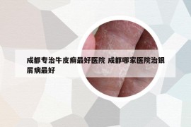 成都專治牛皮癬最好醫(yī)院 成都哪家醫(yī)院治銀屑病最好