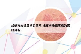 成都市治銀屑病的醫(yī)院 成都市治銀屑病的醫(yī)院排名
