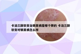 卡泊三醇軟膏治銀屑病是哪個(gè)牌的 卡泊三醇軟膏對(duì)銀屑病怎么樣