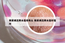 銀屑病流黃水是排毒么 銀屑病流黃水是好是壞