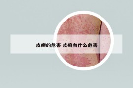皮癬的危害 皮癬有什么危害