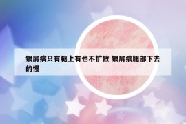 銀屑病只有腿上有也不擴(kuò)散 銀屑病腿部下去的慢