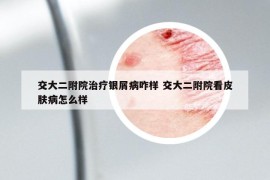 交大二附院治療銀屑病咋樣 交大二附院看皮膚病怎么樣
