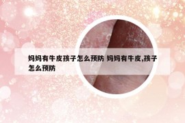 媽媽有牛皮孩子怎么預(yù)防 媽媽有牛皮,孩子怎么預(yù)防