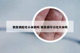 銀屑病能吃小米粥嗎 銀屑病可以吃大米嗎