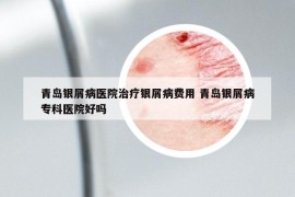 青島銀屑病醫(yī)院治療銀屑病費(fèi)用 青島銀屑病?？漆t(yī)院好嗎