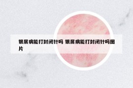 銀屑病能打封閉針嗎 銀屑病能打封閉針嗎圖片
