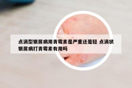 點滴型銀屑病用青霉素是嚴(yán)重還是輕 點滴狀銀屑病打青霉素有用嗎