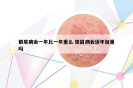 銀屑病會一年比一年重么 銀屑病會逐年加重嗎