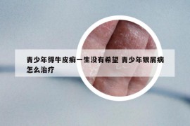 青少年得牛皮癬一生沒有希望 青少年銀屑病怎么治療