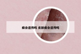 癬會(huì)遺傳嗎 皮膚癬會(huì)遺傳嗎