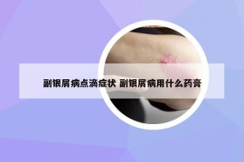 副銀屑病點滴癥狀 副銀屑病用什么藥膏