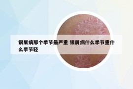 銀屑病那個(gè)季節(jié)最嚴(yán)重 銀屑病什么季節(jié)重什么季節(jié)輕