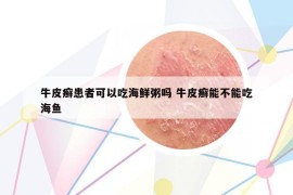 牛皮癬患者可以吃海鮮粥嗎 牛皮癬能不能吃海魚