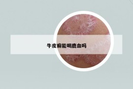 牛皮癬能喝鹿血嗎