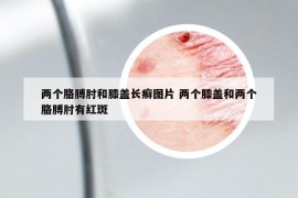 兩個胳膊肘和膝蓋長癬圖片 兩個膝蓋和兩個胳膊肘有紅斑