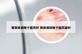 看銀屑病哪個(gè)醫(yī)院好 銀屑病到哪個(gè)醫(yī)院最好