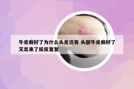 牛皮癬好了為什么頭皮還有 頭部牛皮癬好了又出來了反反復復