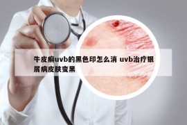 牛皮癬uvb的黑色印怎么消 uvb治療銀屑病皮膚變黑