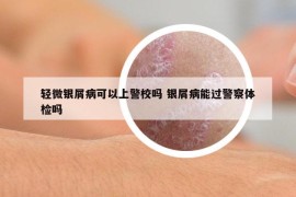 輕微銀屑病可以上警校嗎 銀屑病能過警察體檢嗎