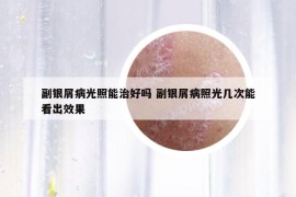 副銀屑病光照能治好嗎 副銀屑病照光幾次能看出效果